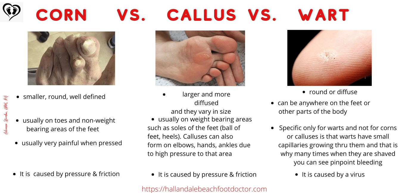 7 Quick Ways To Get Rid of Foot Calluses and Corns – Callus Performance