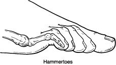 hammertoe