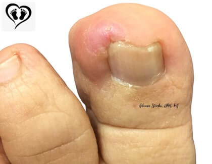 Pin Removal After Hammertoe Surgery - Luxe Foot Surgery