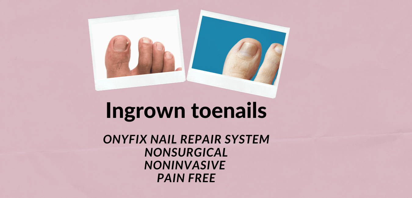 Ingrown toenails