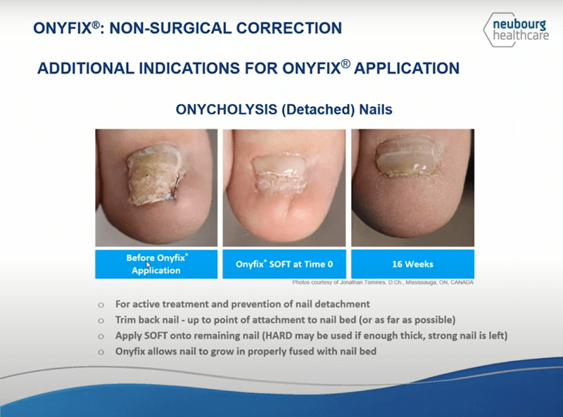 toenail treatment