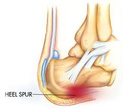 Heel Pain