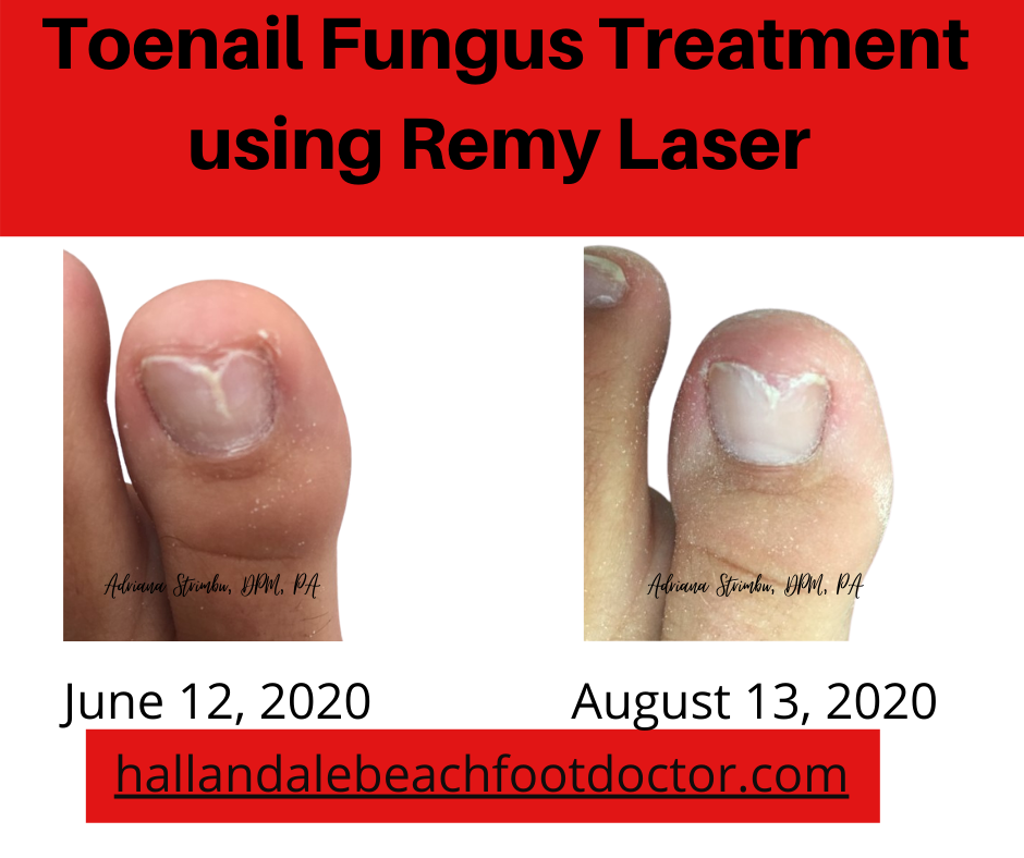 toenail fungus remy laser treatment picture before and after
