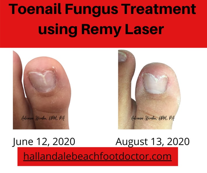 toenail fungus remy laser treatment