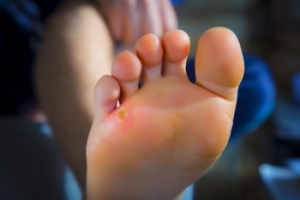 Where Do Foot Corns Develop?