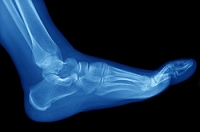 Stress Fractures Happen Gradually