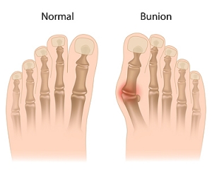 Understanding Bunions
