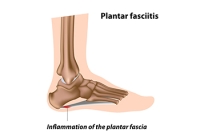 Understanding Plantar Fasciitis and Finding Relief