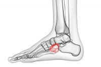 Dealing With Lateral Foot Pain