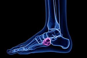 Recovering From Cuboid Syndrome