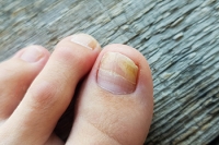 Causes of Toenail Fungus