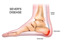 Heel Pain in Growing Children