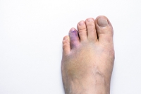 Common Symptoms of a Broken Toe