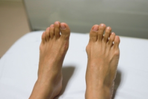 Symptoms Associated With a Bunion