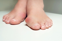 Causes and Symptoms of Bunions